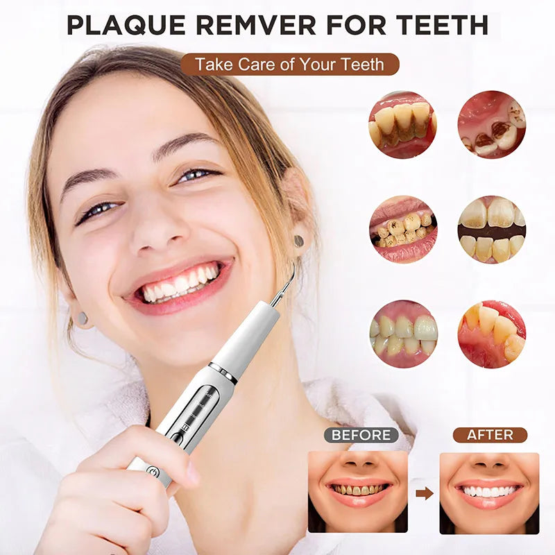 Ultrasonic Dental Scaler