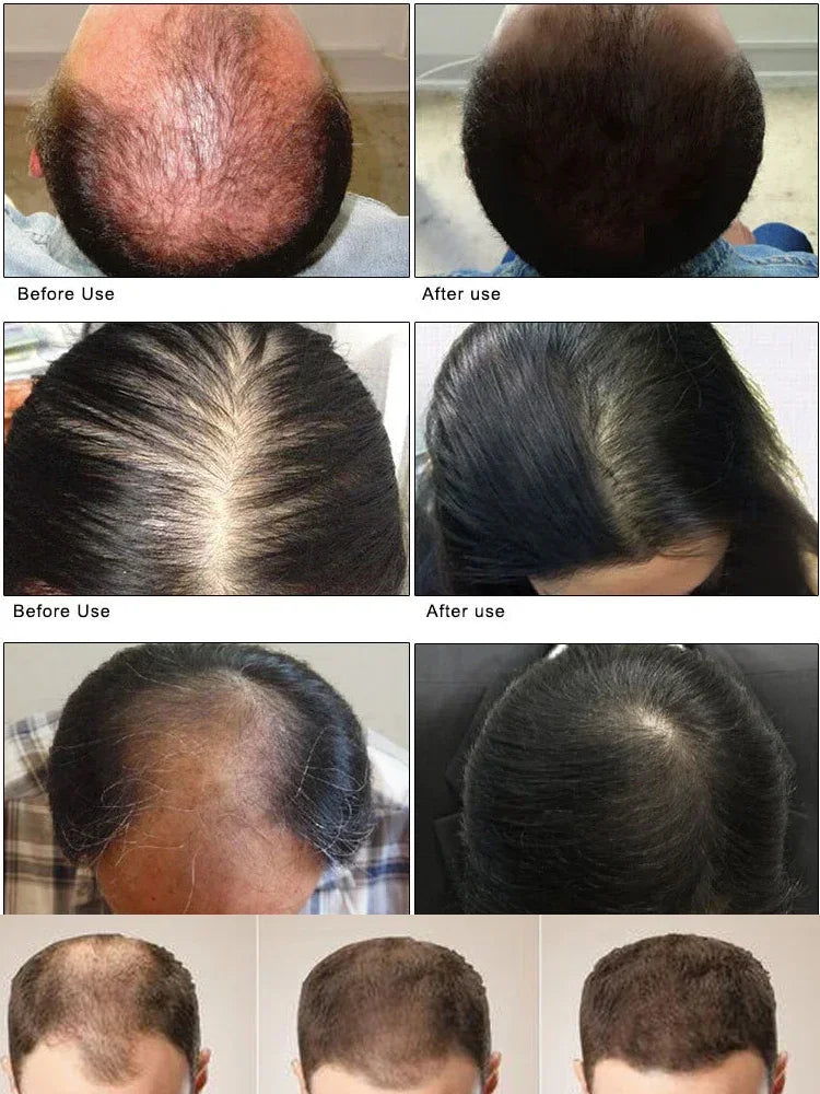 EELHOE Natural Ginger Anti Hair Loss Men Scalp Care Hair Growth Oil Serum