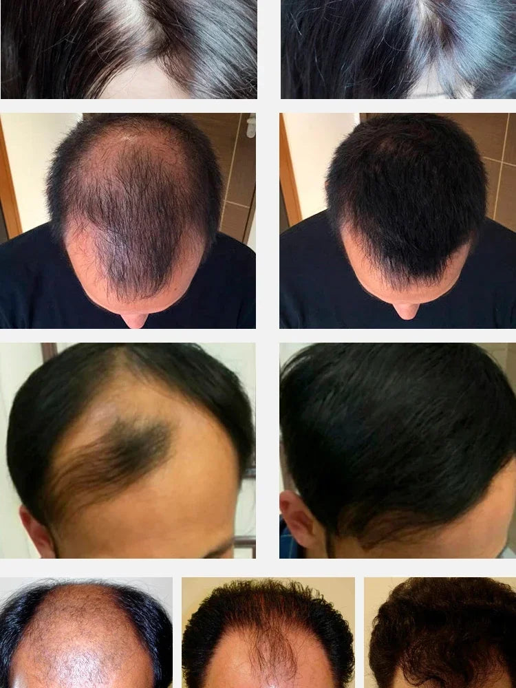 EELHOE Natural Ginger Anti Hair Loss Men Scalp Care Hair Growth Oil Serum